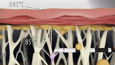 centre-expert-lipoedeme